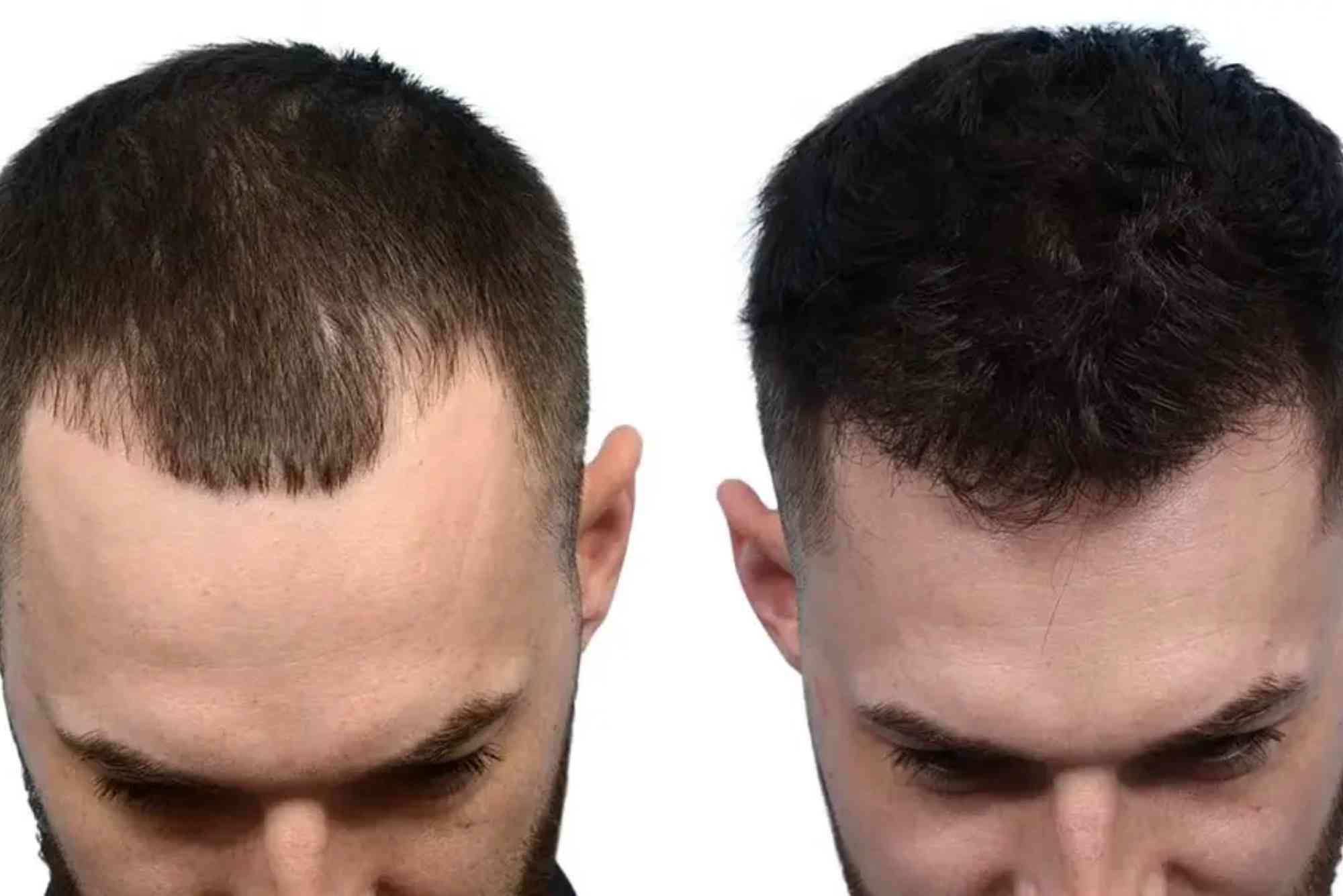 Best Hair Transplat Turkey